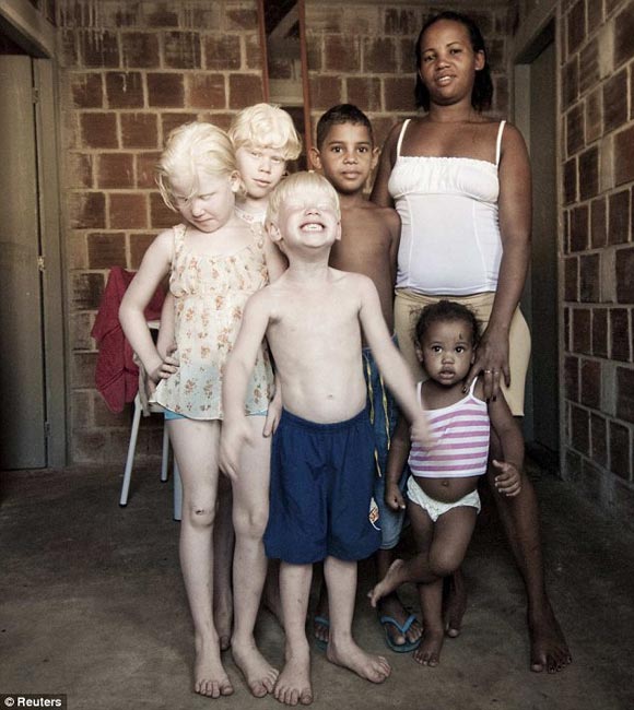 巴西罕见黑人家庭:5个孩子竟有3个患白化病(图)